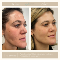 FOREVER YOUNG OR FOREVER CLEAR LASER PACKAGE