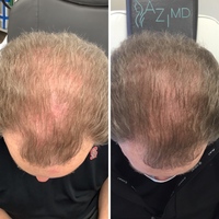 HAIR RESTORATION
