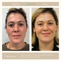 FOREVER YOUNG OR FOREVER CLEAR LASER PACKAGE