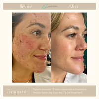 FOREVER YOUNG OR FOREVER CLEAR LASER PACKAGE