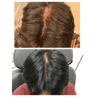HAIR RESTORATION