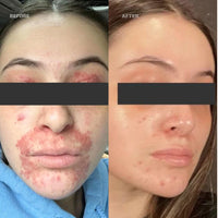 Before and After Azelaic10 - Perioral Dermatitis