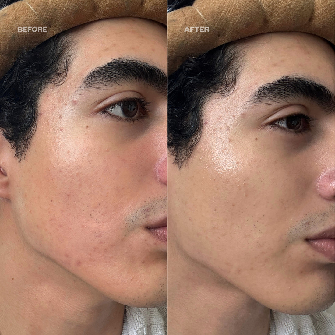 Before and After Azelaic10 - redness + breakouts