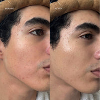 Before and After Azelaic10 - redness + breakouts