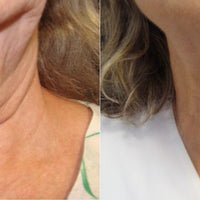 SKIN TIGHTENING PACKAGE