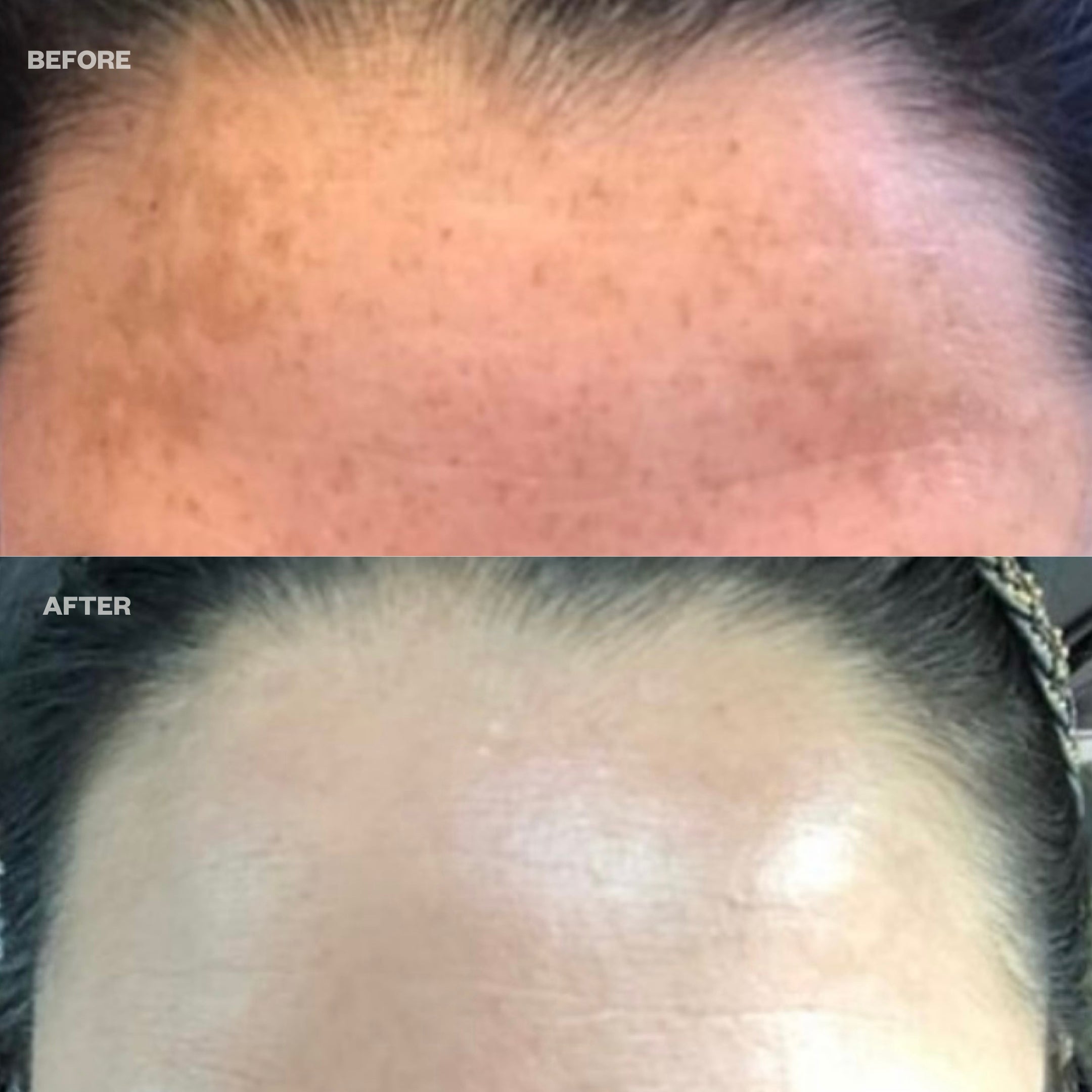 DermaBright MD Pads - Dark Spot Treatment by Dr. Azi | AziMD