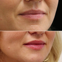 LIP FILLER PURCHASE