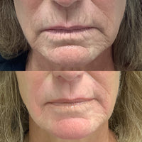 SKIN TIGHTENING PACKAGE