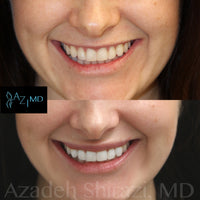 FREE LIP FLIP WITH LIP FILLER PURCHASE