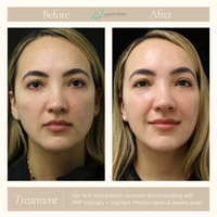 MICRONEEDLING PACKAGE