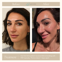 MICRONEEDLING PACKAGE