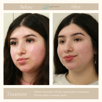 FOREVER YOUNG OR FOREVER CLEAR LASER PACKAGE