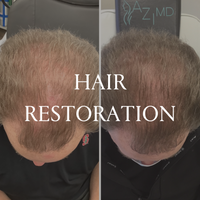 HAIR RESTORATION