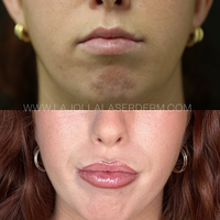 FREE LIP FLIP WITH LIP FILLER PURCHASE