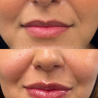 FREE LIP FLIP WITH LIP FILLER PURCHASE