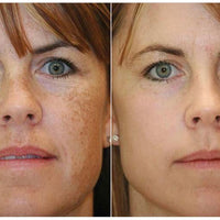 FOREVER YOUNG OR FOREVER CLEAR LASER PACKAGE