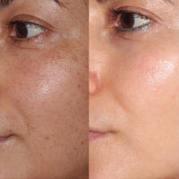 FOREVER YOUNG OR FOREVER CLEAR LASER PACKAGE