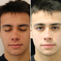 FOREVER YOUNG OR FOREVER CLEAR LASER PACKAGE