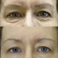 SKIN TIGHTENING PACKAGE