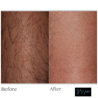 BOGO LASER HAIR REMOVAL PACKAGE