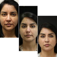 MICRONEEDLING PACKAGE