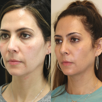 MICRONEEDLING PACKAGE