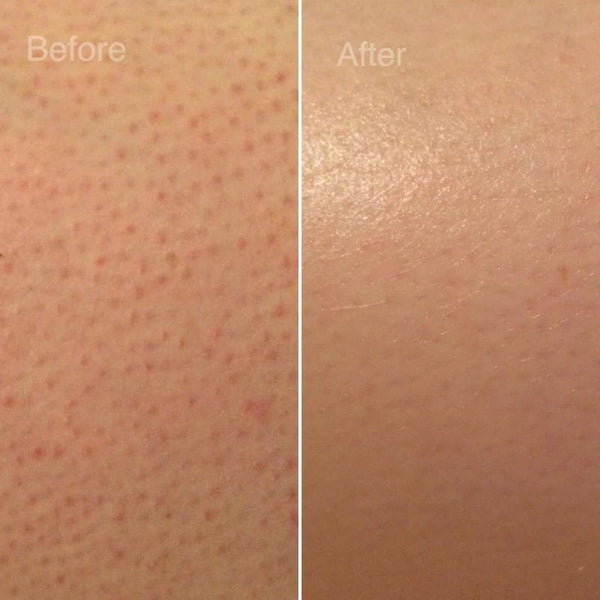 Keratosis Pilaris: What it is & How to Treat it