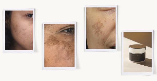 How To Fade Dark Patches After Summer