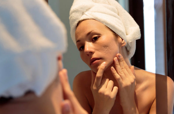 How To Treat Acne Scars (Post Inflammatory Erythema & Hyperpigmentation)