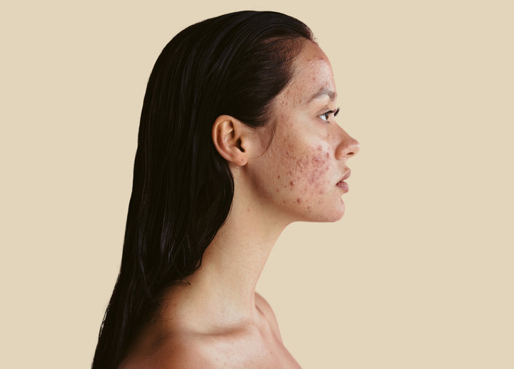 Dermatologist’s Tips for Treating Acne