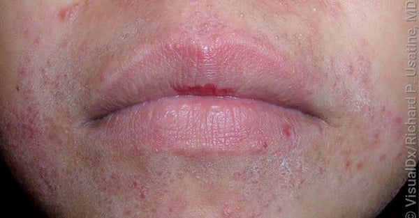 Perioral Dermatitis: Why It Keeps Coming Back (and the Cream Causing It)