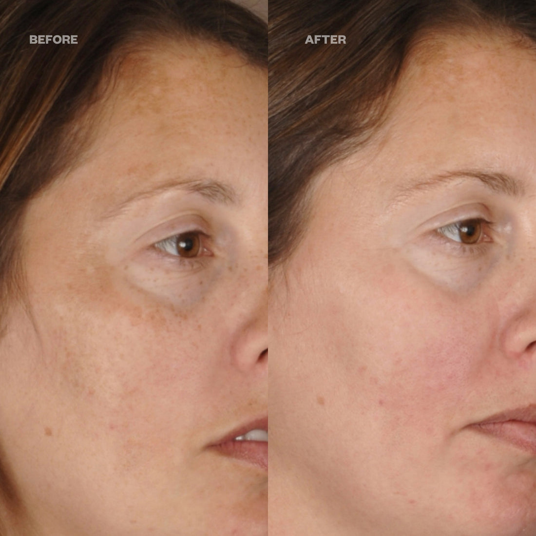 Before and After - Melasma treatment using DermaBright Pads