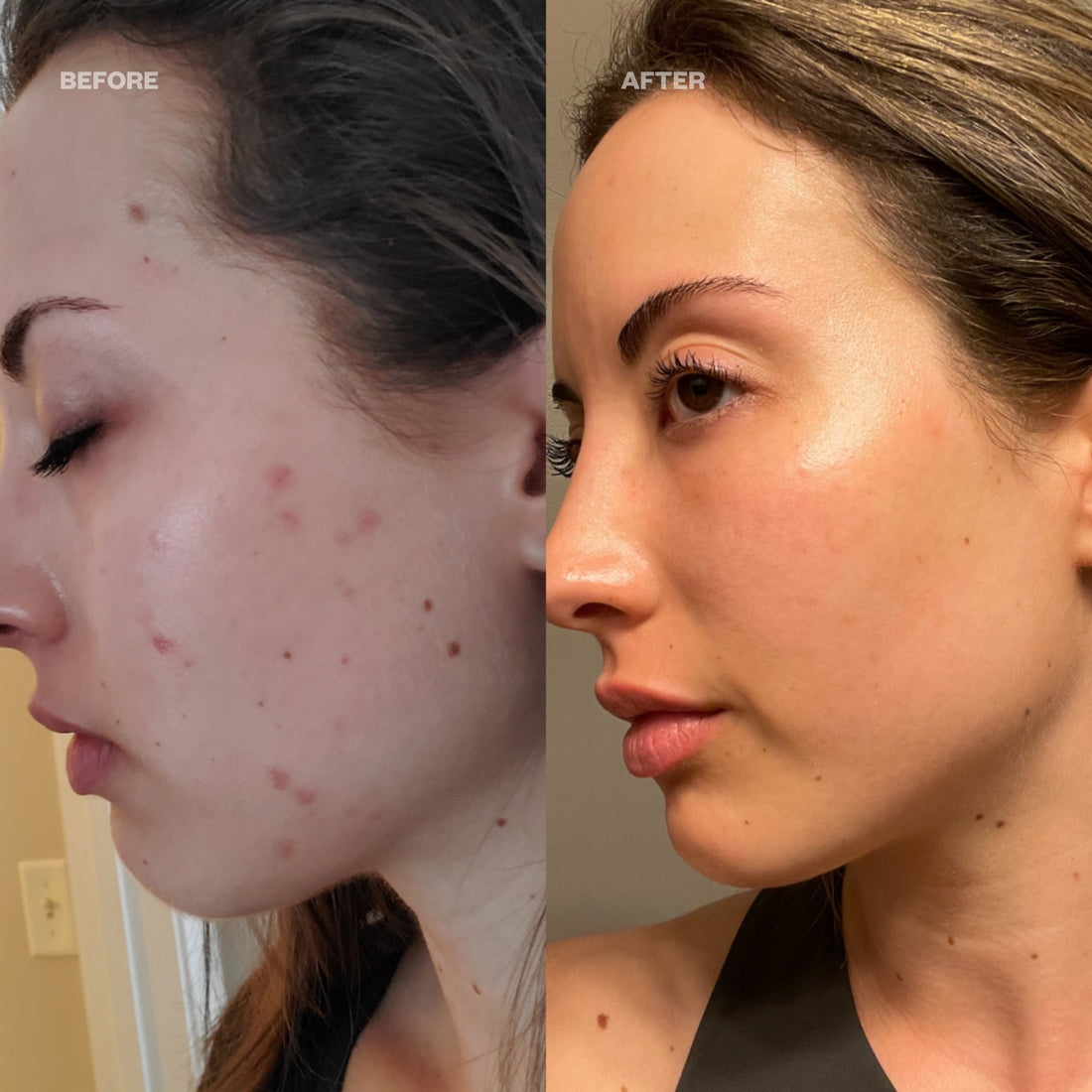 Before and After - post-inflammatory hyperpigmentation treatment. Using DermaBright Pads