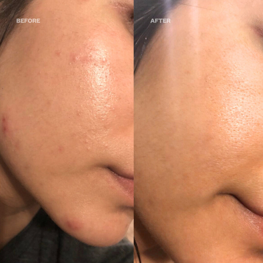 Clarify Pads before and after results from breakouts and post inflammatory hyperpigmentation