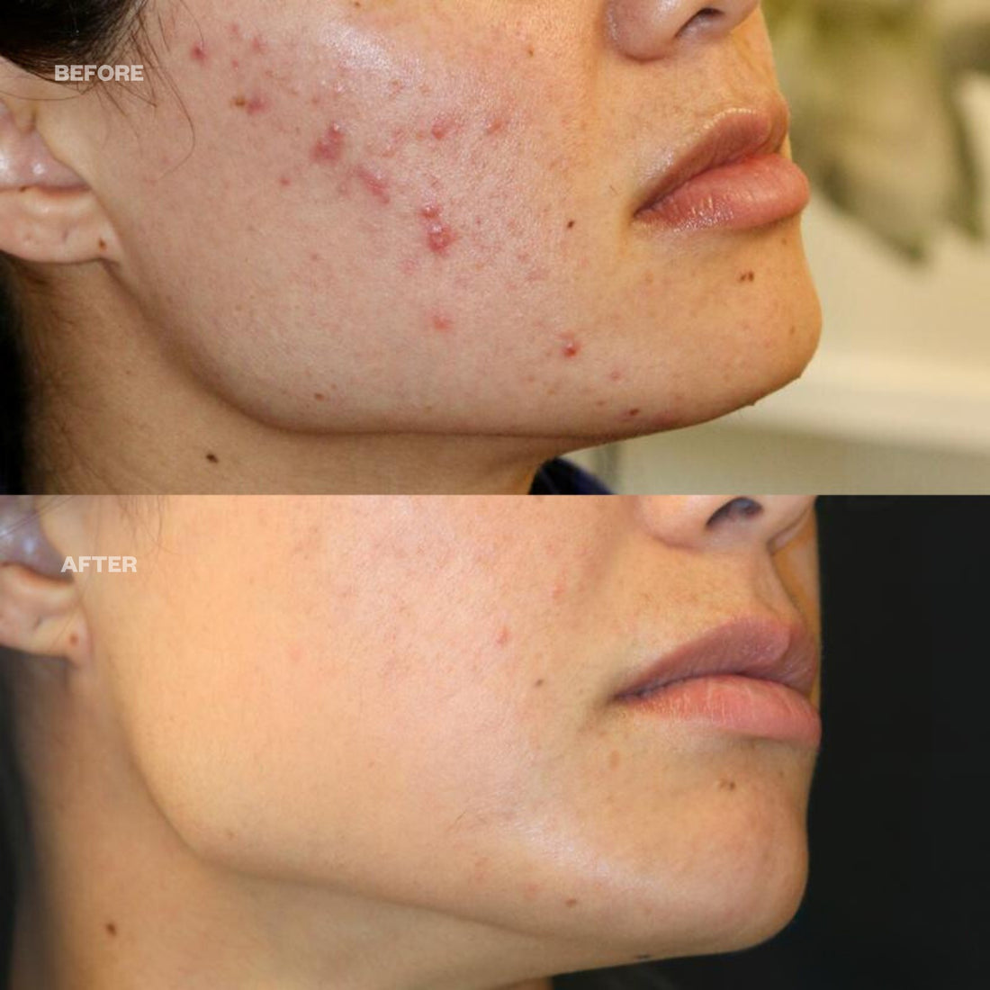 Before and after breakouts - Detox Mask