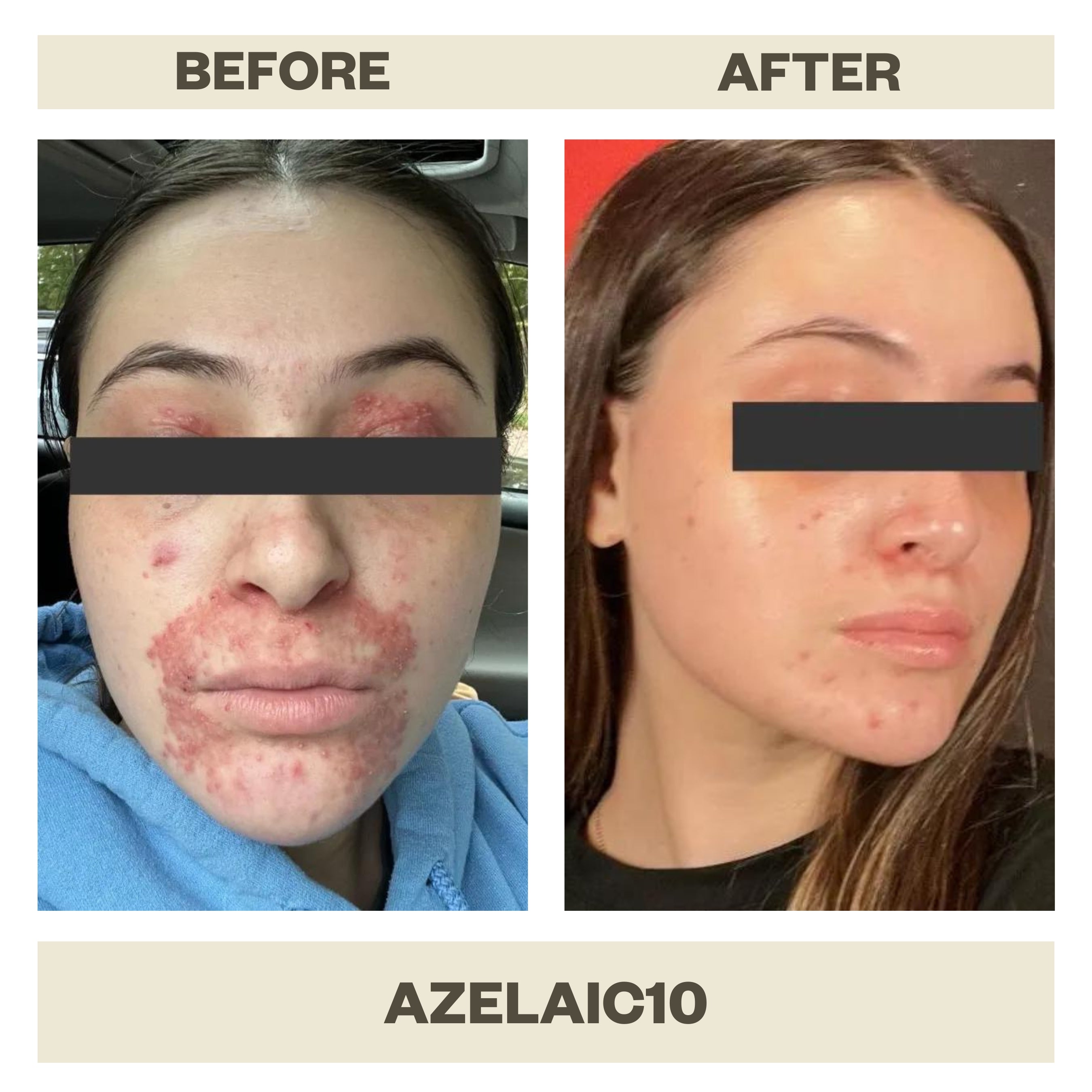 Azelaic10 Serum | Azelaic Acid 10% Serum | AziMD Skincare