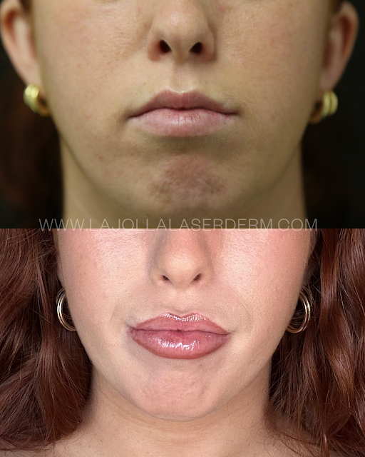 FREE LIP FLIP WITH LIP FILLER PURCHASE