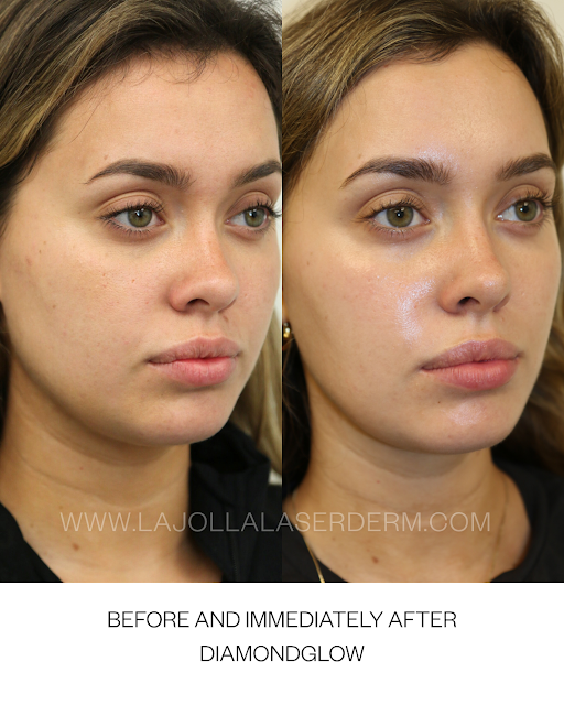 DIAMOND GLOW FACIAL PACKAGE