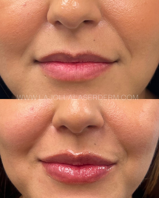 FREE LIP FLIP WITH LIP FILLER PURCHASE