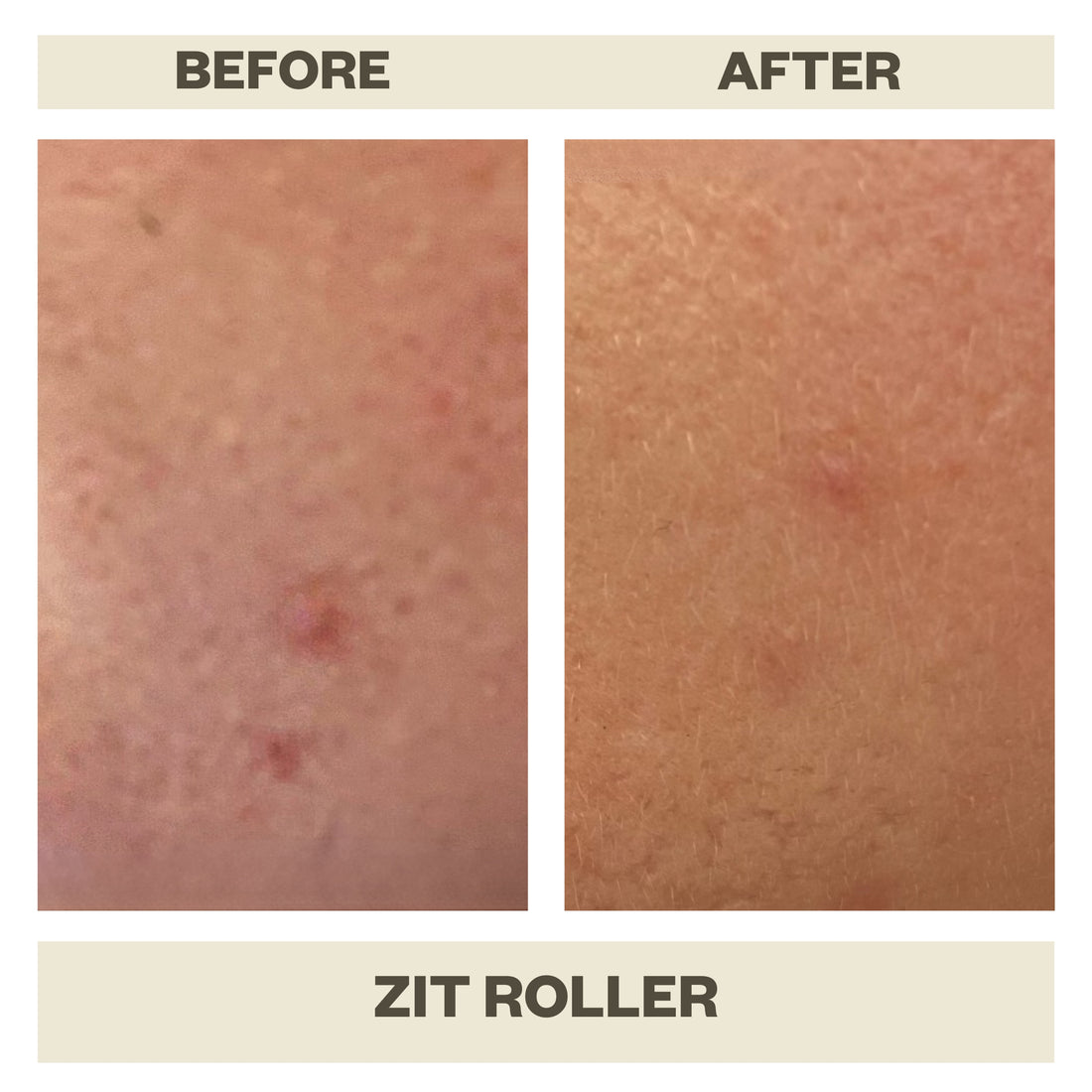 ZIT ROLLER