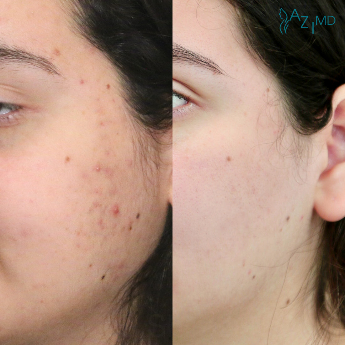 Woman's Cheek Before and After Using Foaming Facial Cleanser