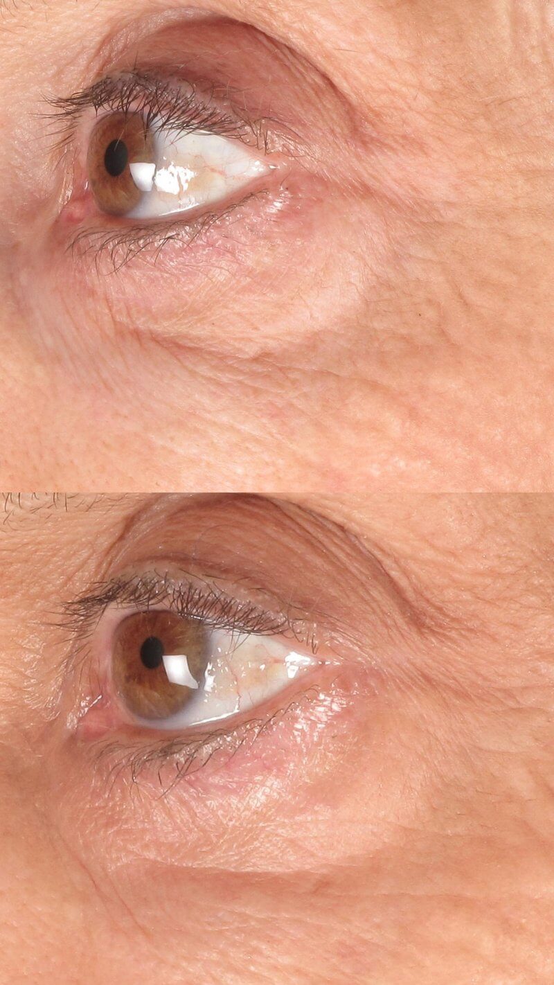 Woman Before and After Using Eye Skin Care Kit