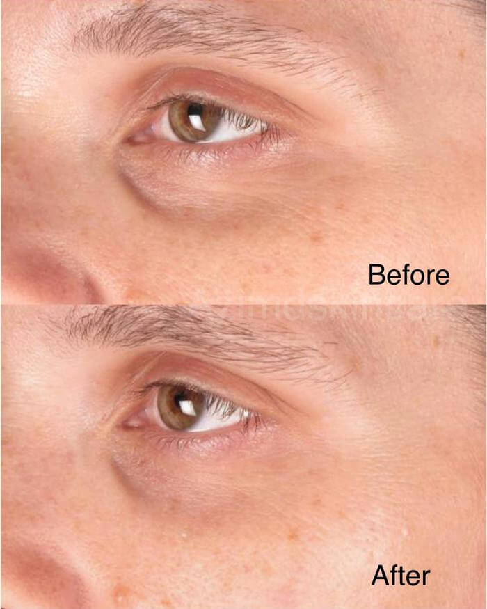 Person Before and After Using Eye Skin Care Kit
