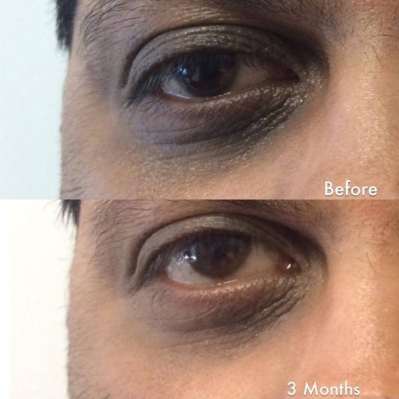 Man Before and After Using Eye Skin Care Kit