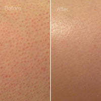 Skin Before and After Using Acne Treatment Kit