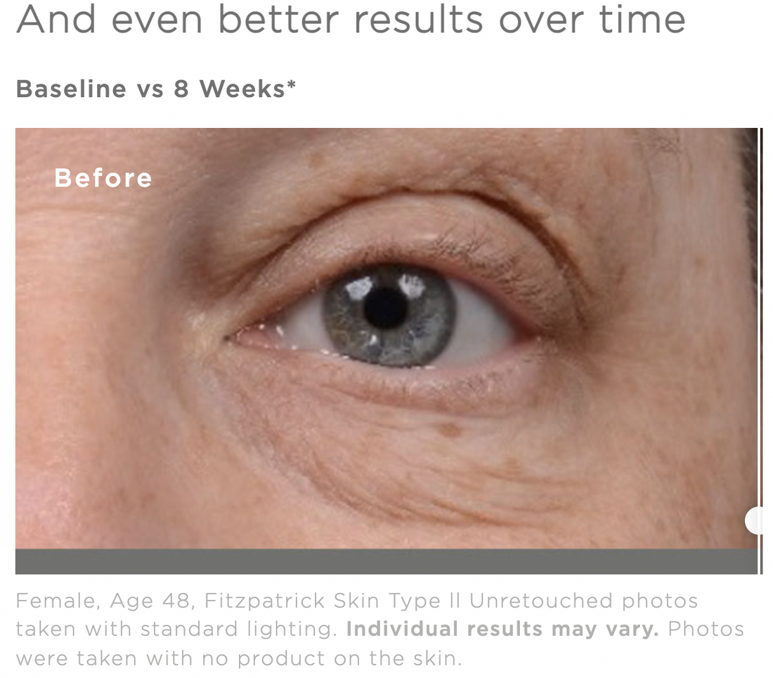 Woman's Eye Before Using Wrinkle and Puffy Eye Treatment
