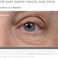 Woman's Eye Before Using Wrinkle and Puffy Eye Treatment