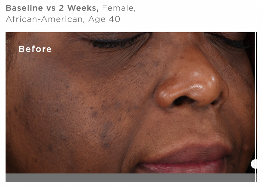 Before Using Skin Discoloration Treatment