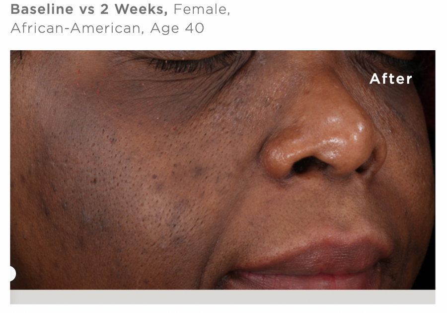 After Using Skin Discoloration Treatment