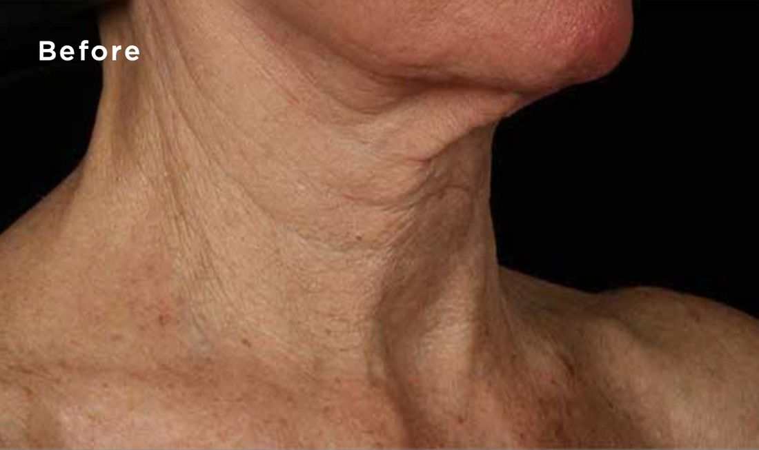 Woman's Neck Before Using Anti Aging Neck Skincare Cream Product